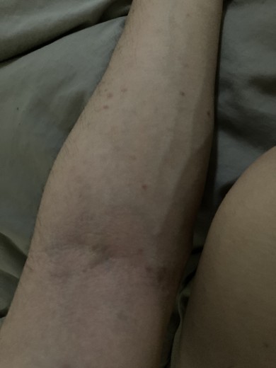 after photo: エクソソーム, 美容注射・点滴