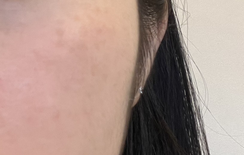 before photo: 피코토닝