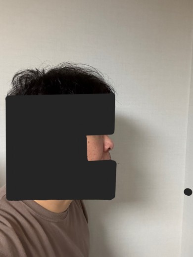 after photo: 눈밑지방재배치