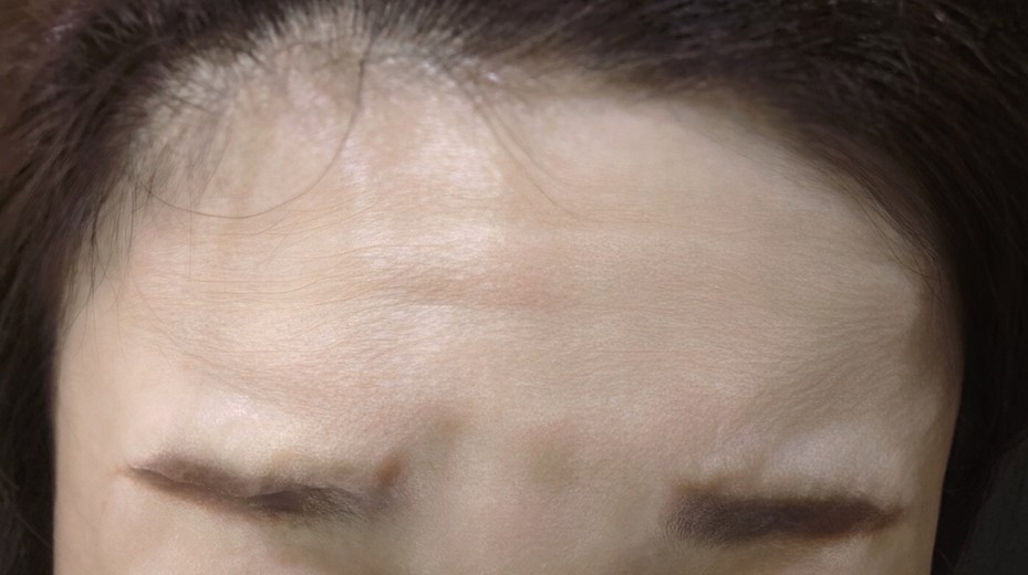 before photo: 額のしわボトックス