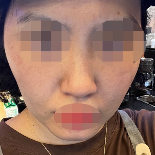 before photo: 콧볼축소