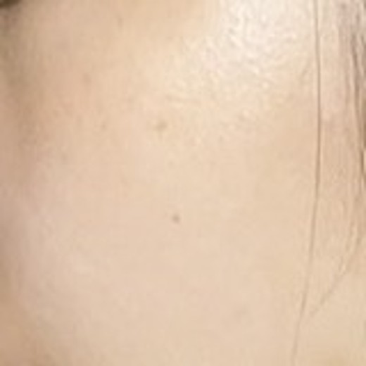 before photo: ピコトーニング