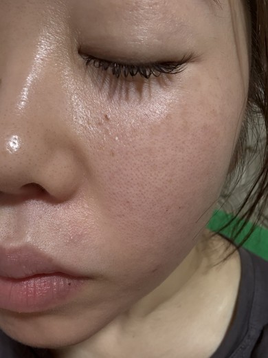after photo: IPL(光/フォト治療), ルメッカ