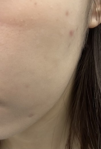 before photo: 피코토닝, 제네시스