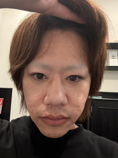 before photo: ダーマペン