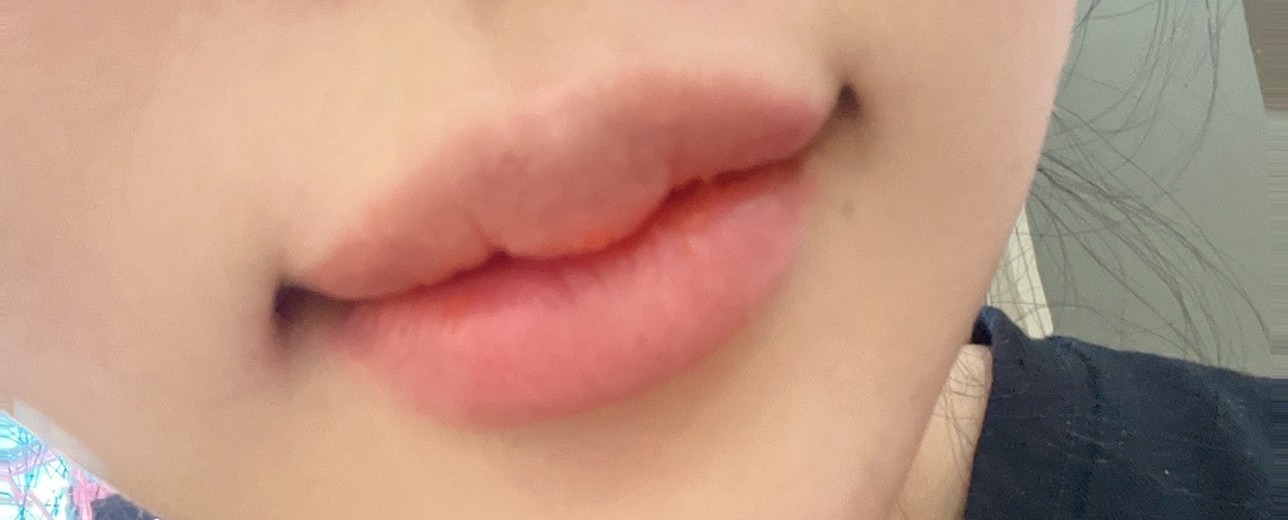 after photo: 실리프팅, 입꼬리성형