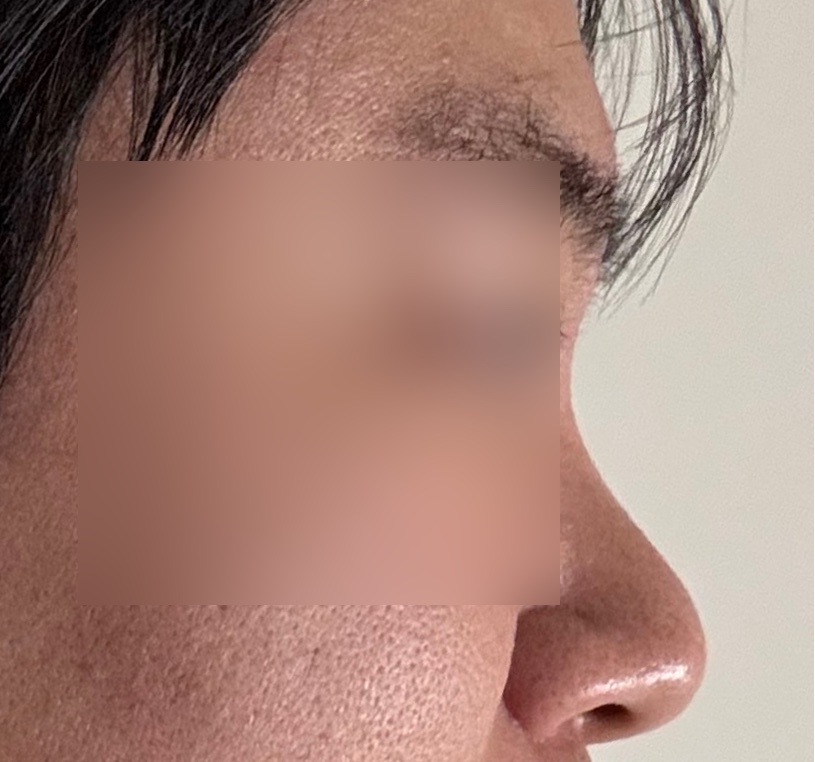 시술 전