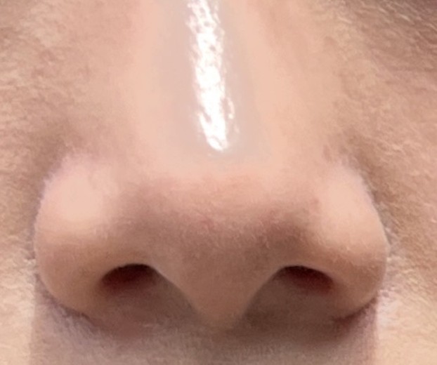 after photo: 콧볼축소