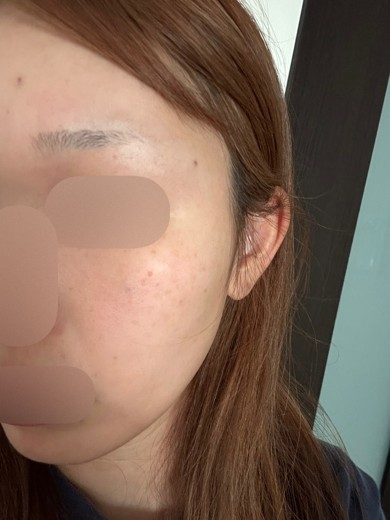 after photo: スキンボトックス