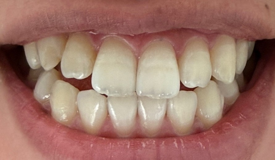 after photo: ホワイトニング