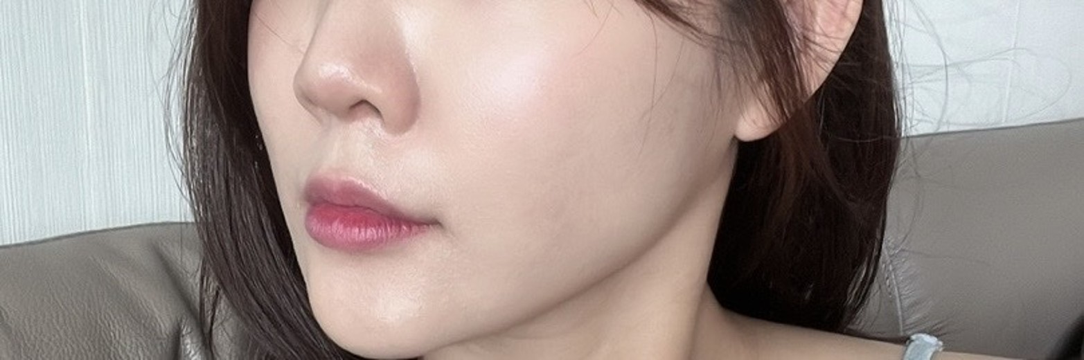 after photo: PRP피부재생술