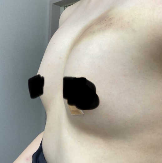after photo: 豊胸(脂肪注入)