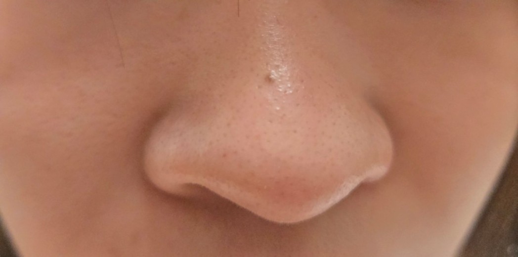 after photo: スキンボトックス