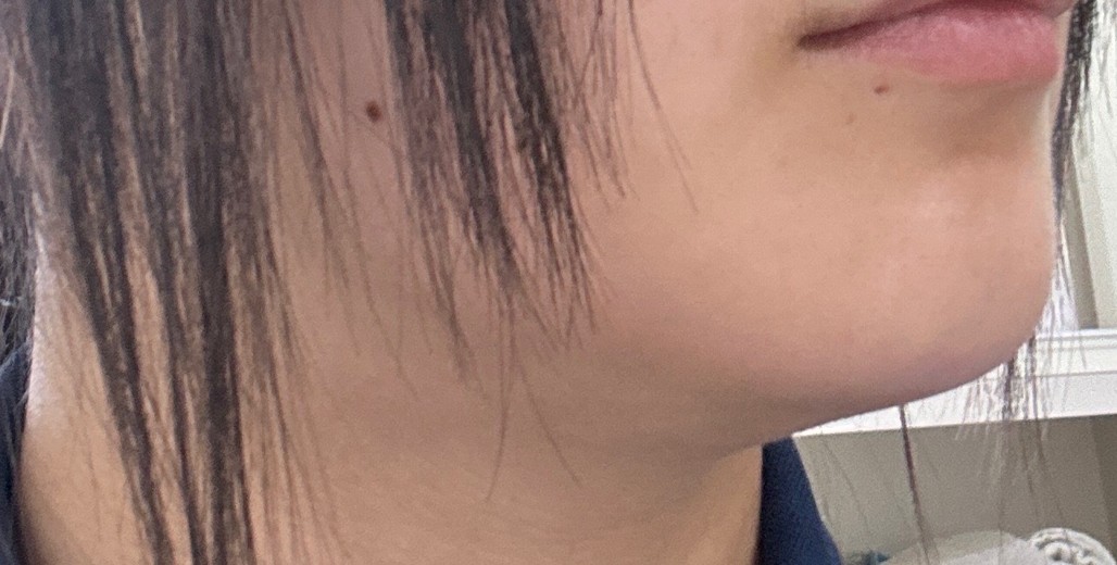 after photo: 脂肪溶解注射(顔)
