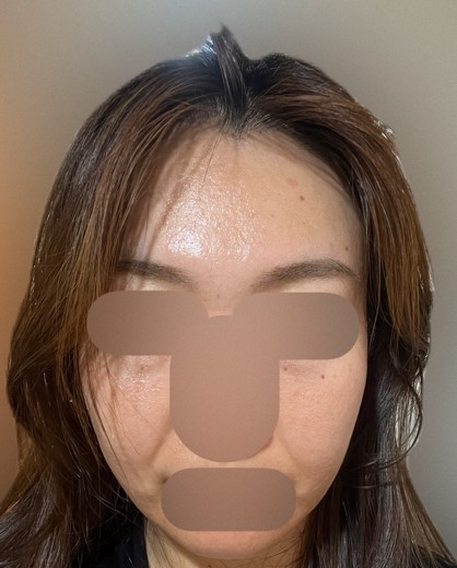 after photo: IPL(光/フォト治療), ピーリング, エレクトロポレーション