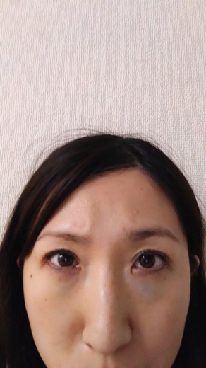 after photo: 脱脂(クマ治療)