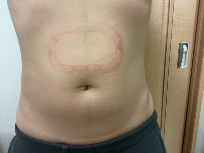 after photo: 脂肪冷却(腹部)
