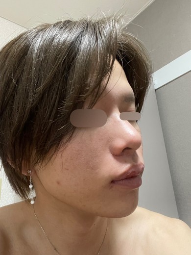 before photo: ダーマペン
