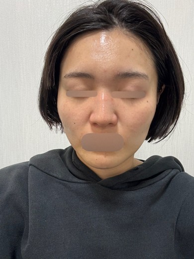 after photo: IPL(光/フォト治療), ピーリング, エレクトロポレーション