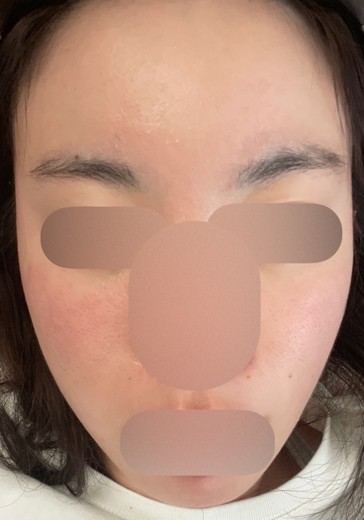 after photo: ダーマペン