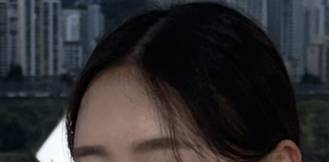 after photo: 이마필러