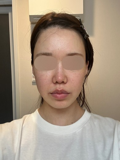 before photo: IPL(光/フォト治療)