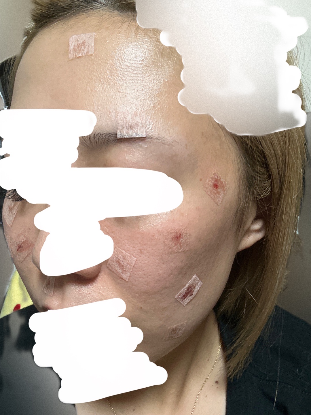 再来OK】シミほくろ（15個まで）顔・身体どこでも可能｜診察料・麻酔代