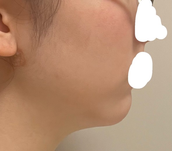 after photo: 脂肪吸引(顎下)