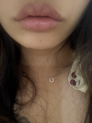 after photo: 입꼬리필러, 입꼬리보톡스