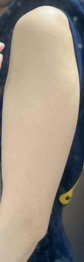 after photo: 脂肪溶解注射(腕)