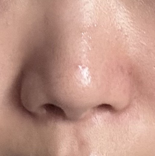 before photo: 콧볼축소