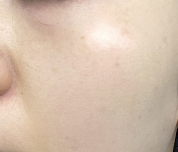 before photo: IPL(光/フォト治療)