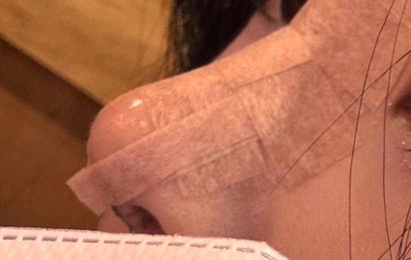 after photo: 콧대(보형물), 코끝(자가연골)
