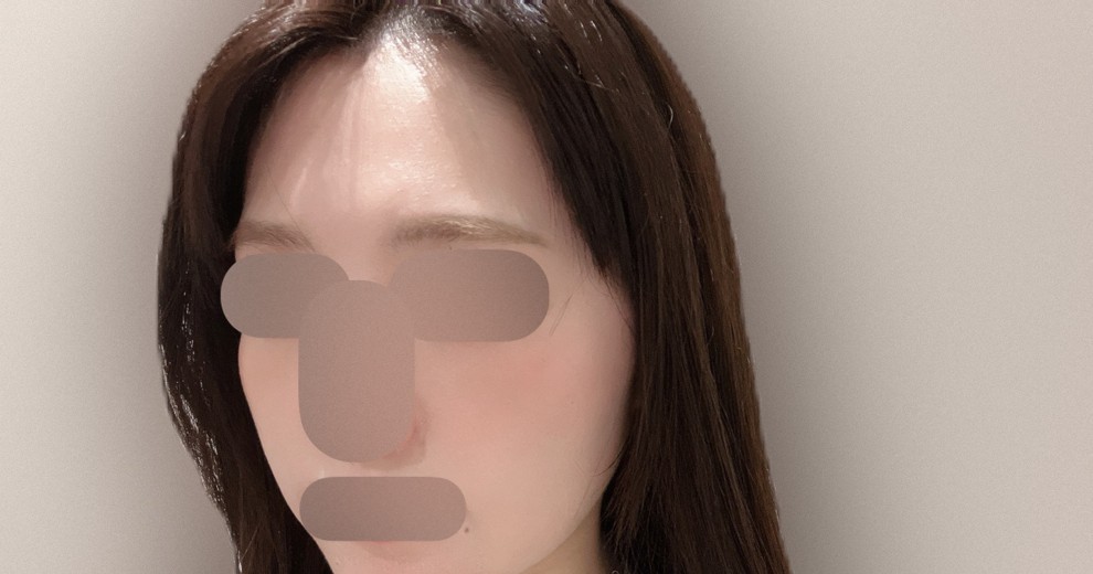 after photo: 額のしわボトックス