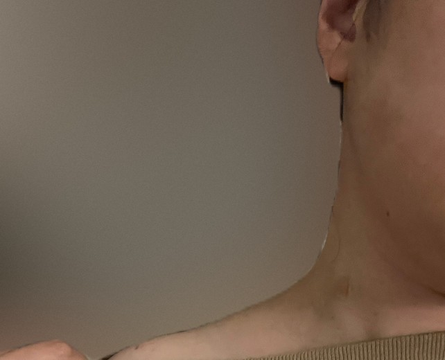 after photo: 승모근보톡스