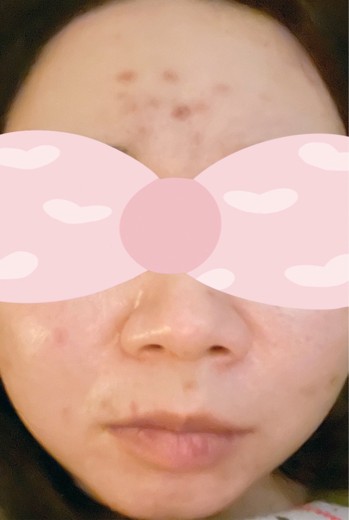 before photo: ジュベルック(Juvelook), サブシジョン(ニキビ跡治療)