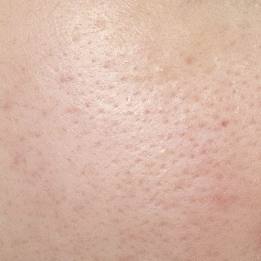 after photo: 아쿠아필링