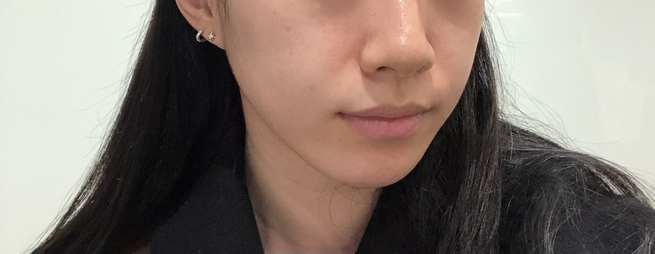 before photo: 입꼬리필러, 입술필러