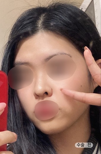 before photo: 콧대(자가조직), 코끝(자가연골)