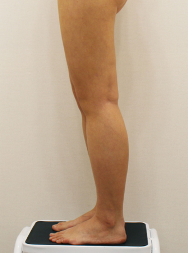 after photo: 허벅지지방흡입