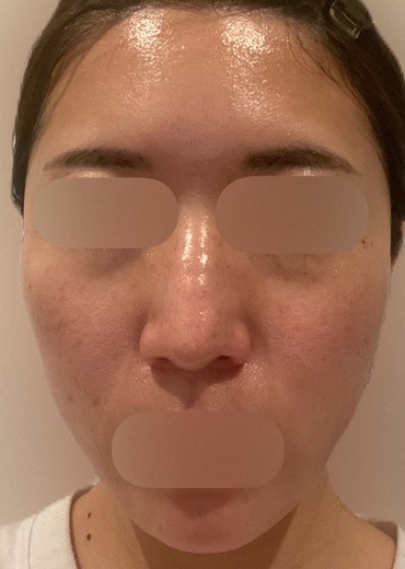 before photo: フラクショナルレーザー, ピコトーニング, 診断・検査