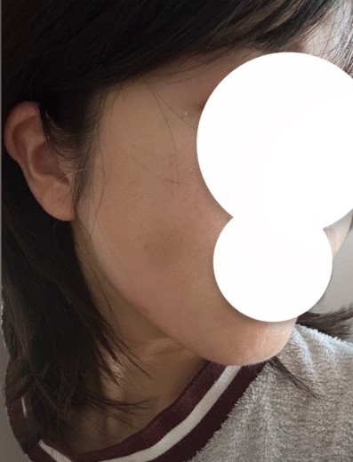 after photo: チタニウムリフト