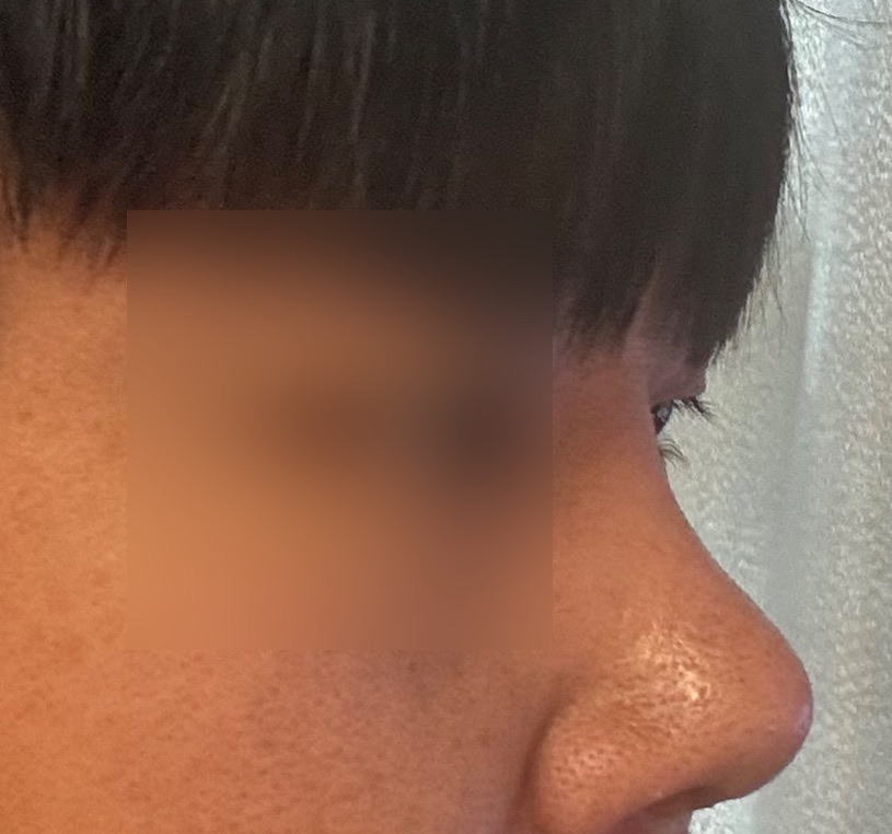 시술 후