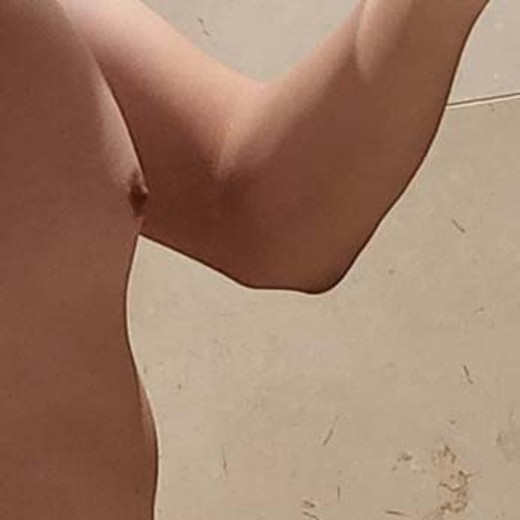 before photo: 여유증수술