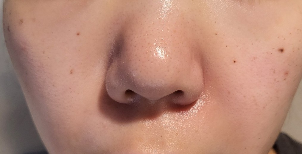 after photo: IPL(光/フォト治療), 診断・検査