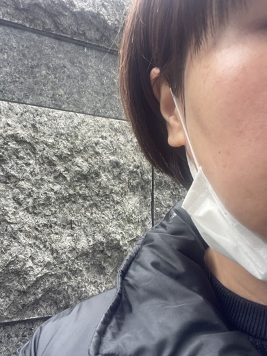 after photo: エレクトロポレーション, ララピール(LHAピーリング)