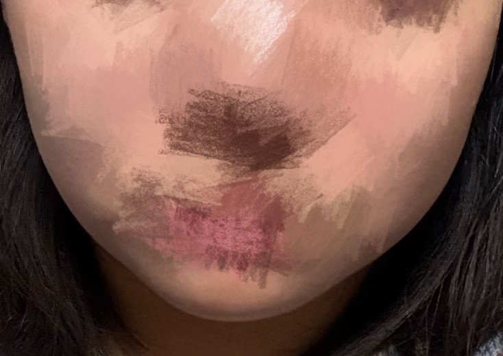 after photo: 脂肪溶解注射(顔)