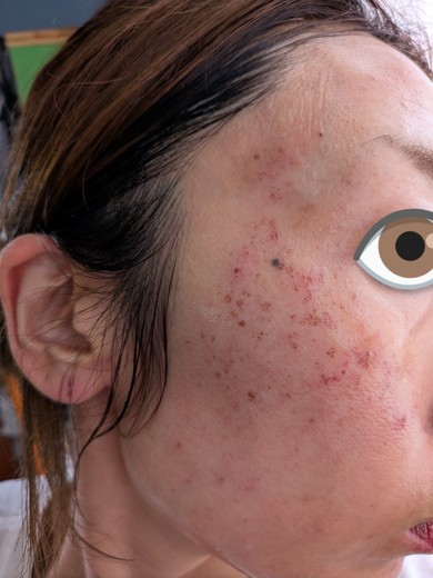 after photo: IPL(光/フォト治療), ルメッカ