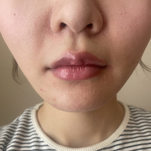 after photo: ダーマペン