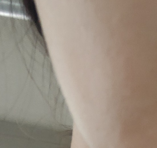 after photo: 옆볼필러